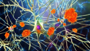 Разрушение амилоидных бляшек при болезни Альцгеймера может навредить пациентам
