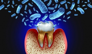 Dental Research: пародонтит повышает риск инсульта у людей моложе 50 лет