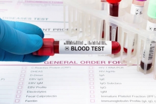 ScienceAlert: вторую группу крови связали с повышенным на 16 % риском раннего инсульта