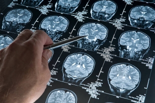 Электростимуляция мозга может улучшить когнитивные функции при болезни Альцгеймера
